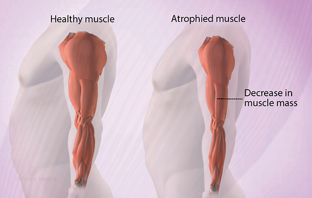 Muscular dystrophy – also known as: MD · Source: Focus Medica