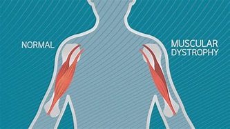 Quality of life in adults with muscular dystrophy