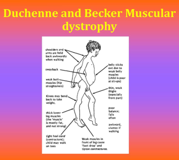 Understanding the Similarities and Differences Between Duchenne and Becker Muscular Dystrophy
