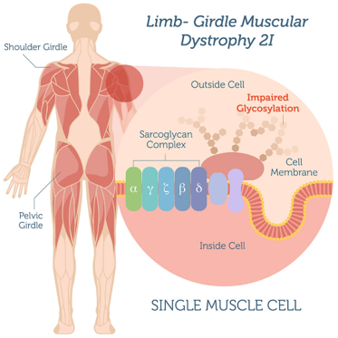 Limb-Girdle Muscular Dystrophy (LGMD)