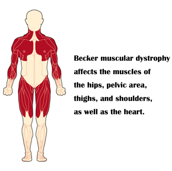 Becker Muscular Dystrophy (BMD)