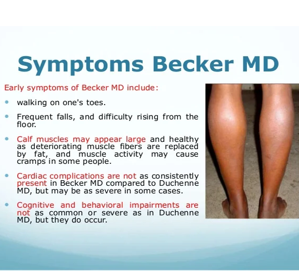 Signs and Symptoms – Becker Muscular Dystrophy (BMD)
